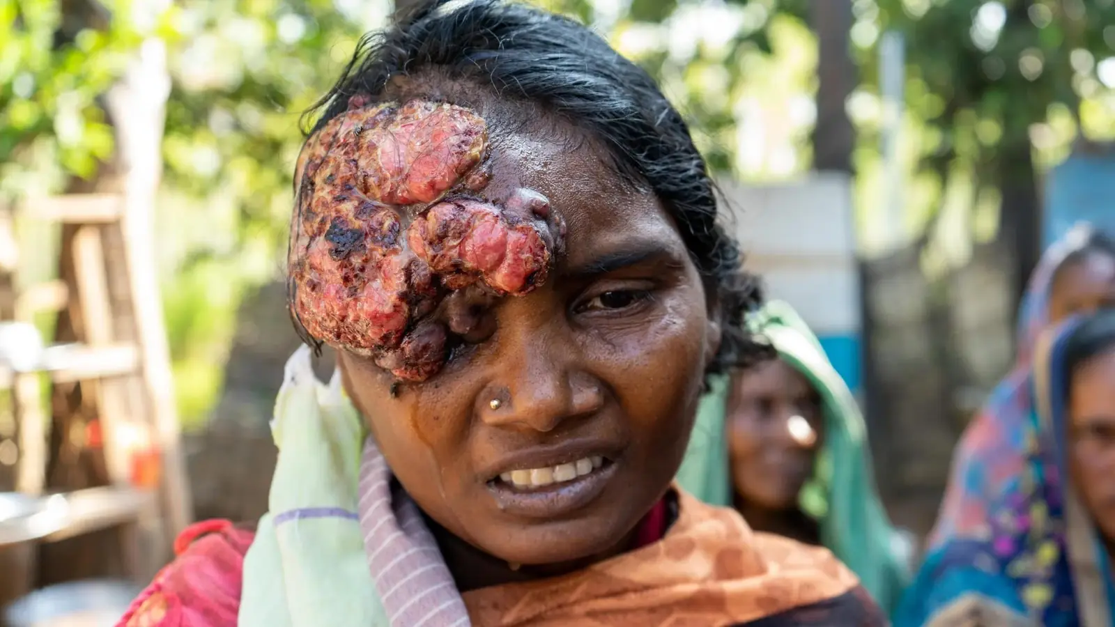 Nagamani before receiving treatment